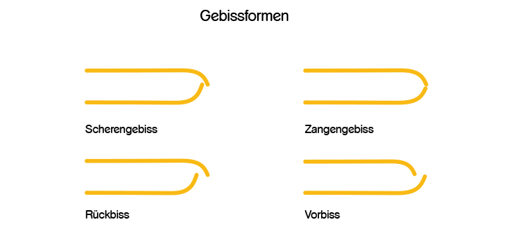 Schema Darstellungen von vier verschiedenen Gebissfehlstellungen